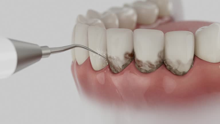 Reliable Wisdom Tooth Removal contractor in Sage, CA by Smile Center Dentistry